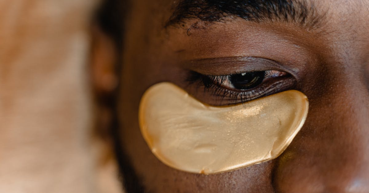 Dark Circles Under Eyes: Causes, Types, and Treatments That Match Your Type